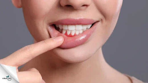 Възпалени венци: Възможни причини и ефикасни лечения